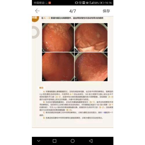H.pylori除菌后發(fā)現(xiàn)胃癌的內鏡診斷