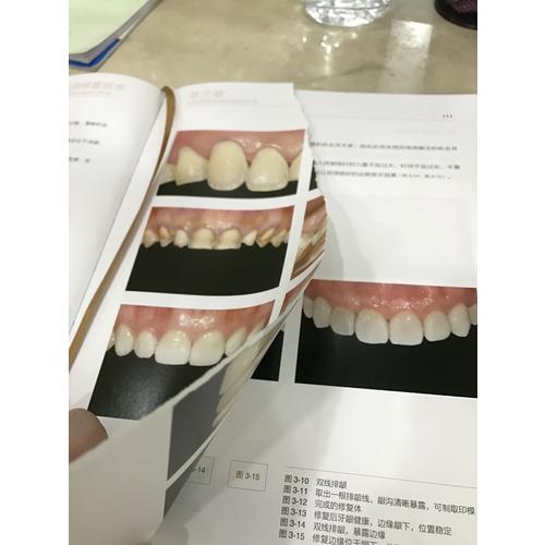 瓷貼面修復技術·從標準到微創無預備