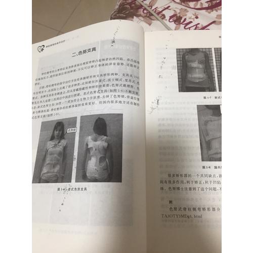 脊柱側(cè)彎的保守治療
